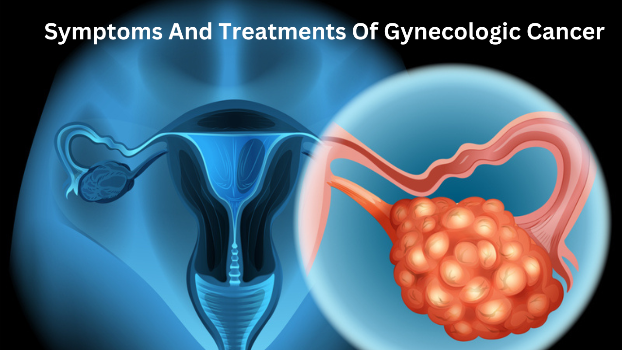 Symptoms And Treatments Of Gynecologic Cancer